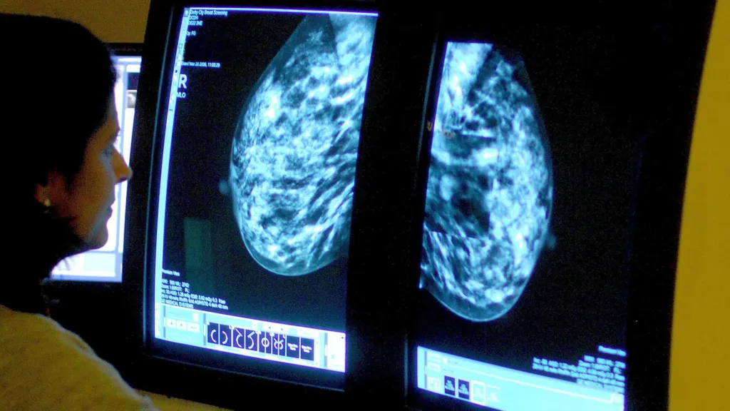 Breast cancer survivors face lower second cancer risk than thought