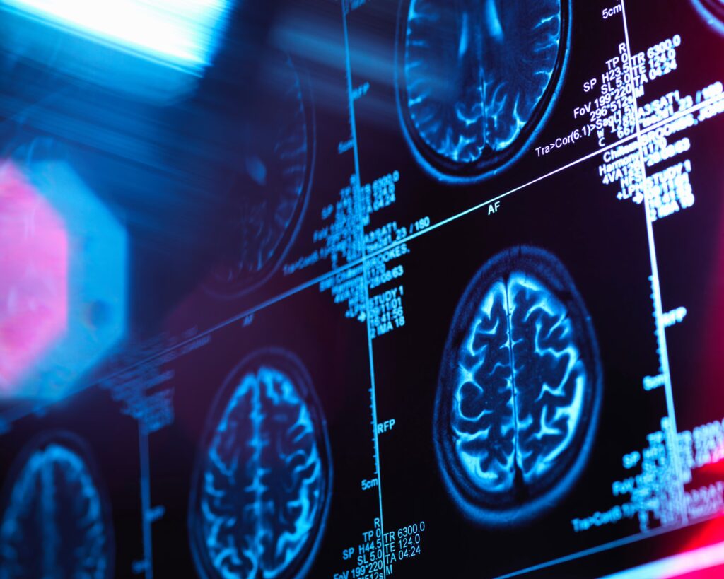 Study Finds Children’s Brain Development Altered by Income Inequality