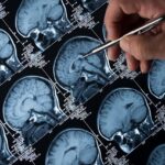 Gene Therapy AMT-130 Shows Promise in Slowing Huntington’s Disease-thumbnail