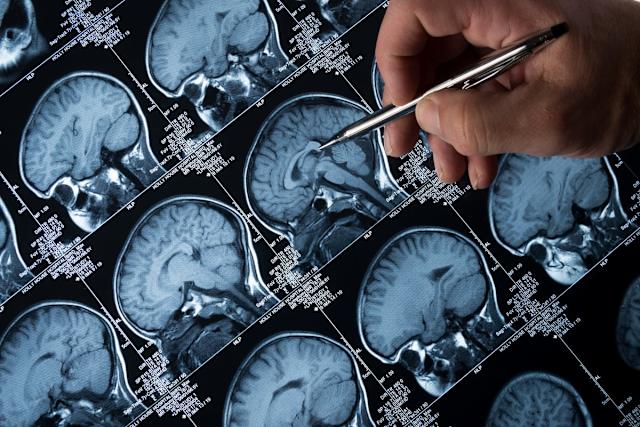 Gene Therapy AMT-130 Shows Promise in Slowing Huntington’s Disease