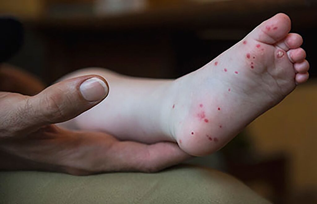 Hand, Foot and Mouth Disease on the Rise: Symptoms, Treatment, and Prevention-thumbnail