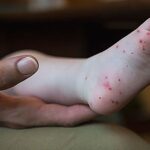 Hand, Foot and Mouth Disease on the Rise: Symptoms, Treatment, and Prevention-thumbnail