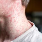 Measles Cases Surge Past 2,000 in US, Threatening Elimination
