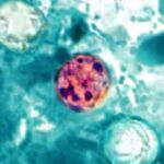 Cyclospora Outbreak Reaches 1,000 Cases in Michigan, Source Unknown-thumbnail