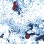 First Deaths Reported in US Cyclospora Outbreak as Cases Top 18,000-thumbnail